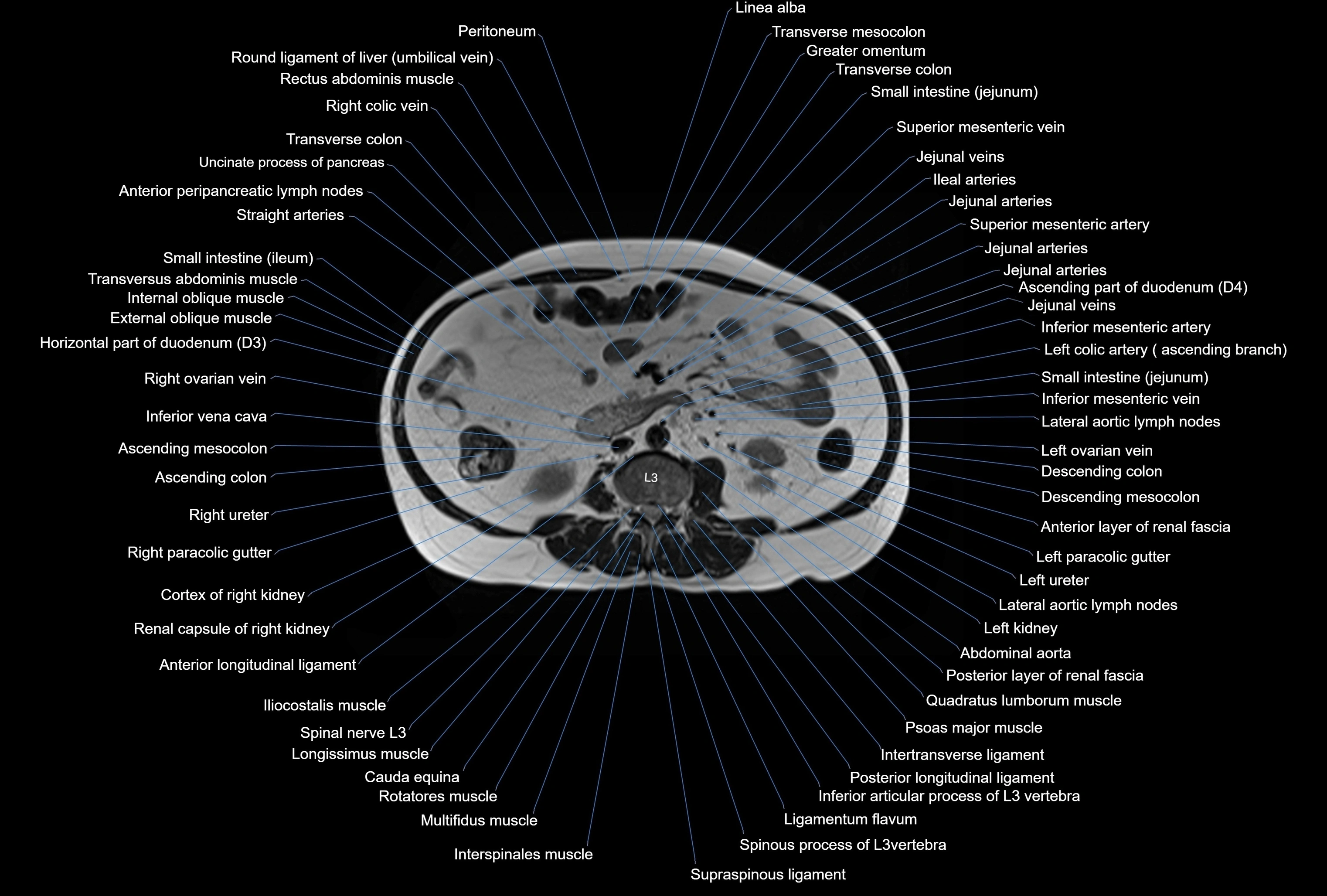 MRI Abdomen axial cross sectional anatomy radiology  image-img-00001-00027.webp